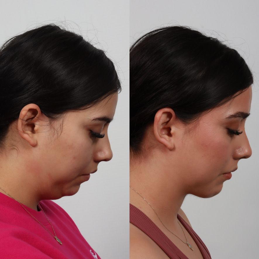 Deep Plane Neck Lift Before & After