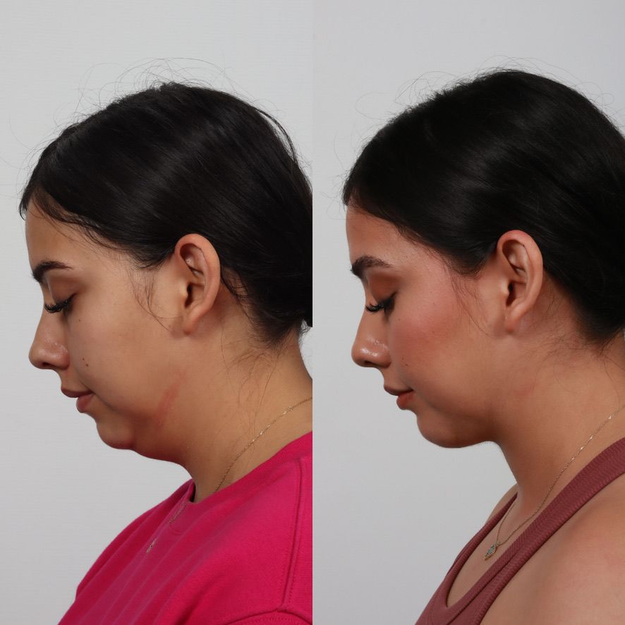 Deep Plane Neck Lift Before & After