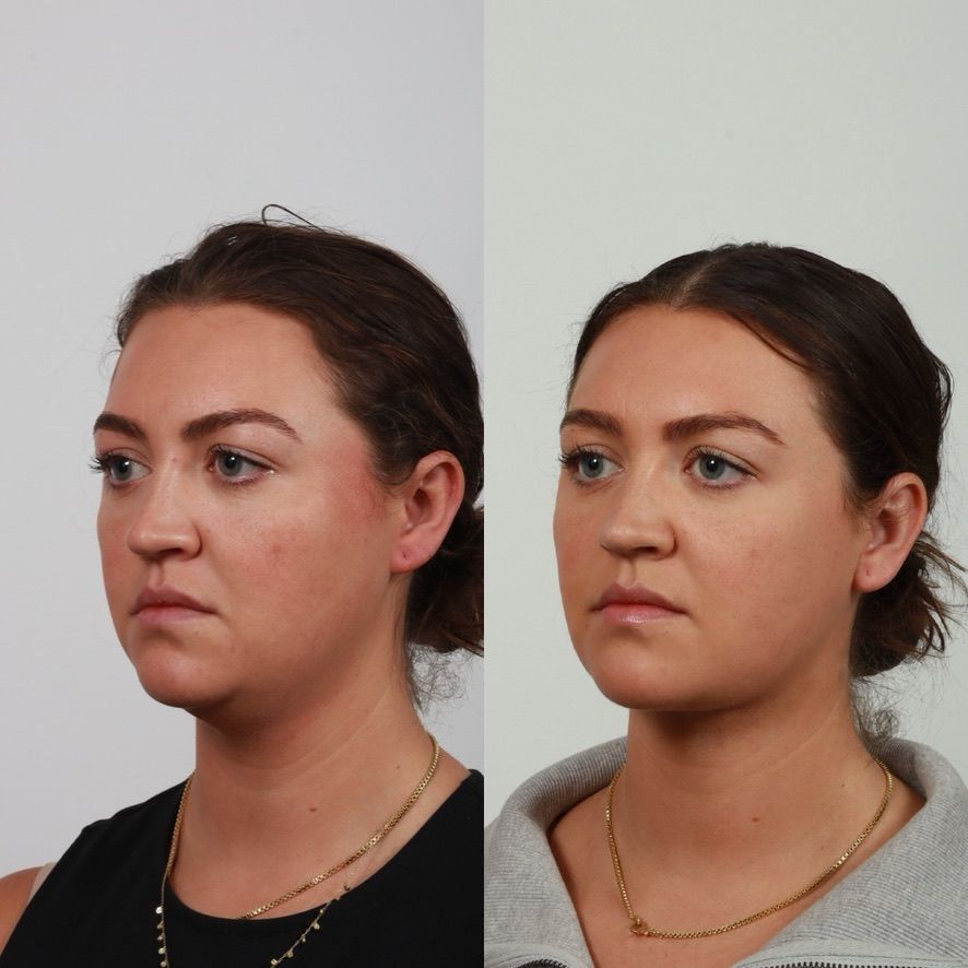 Deep Plane Neck Lift Before & After