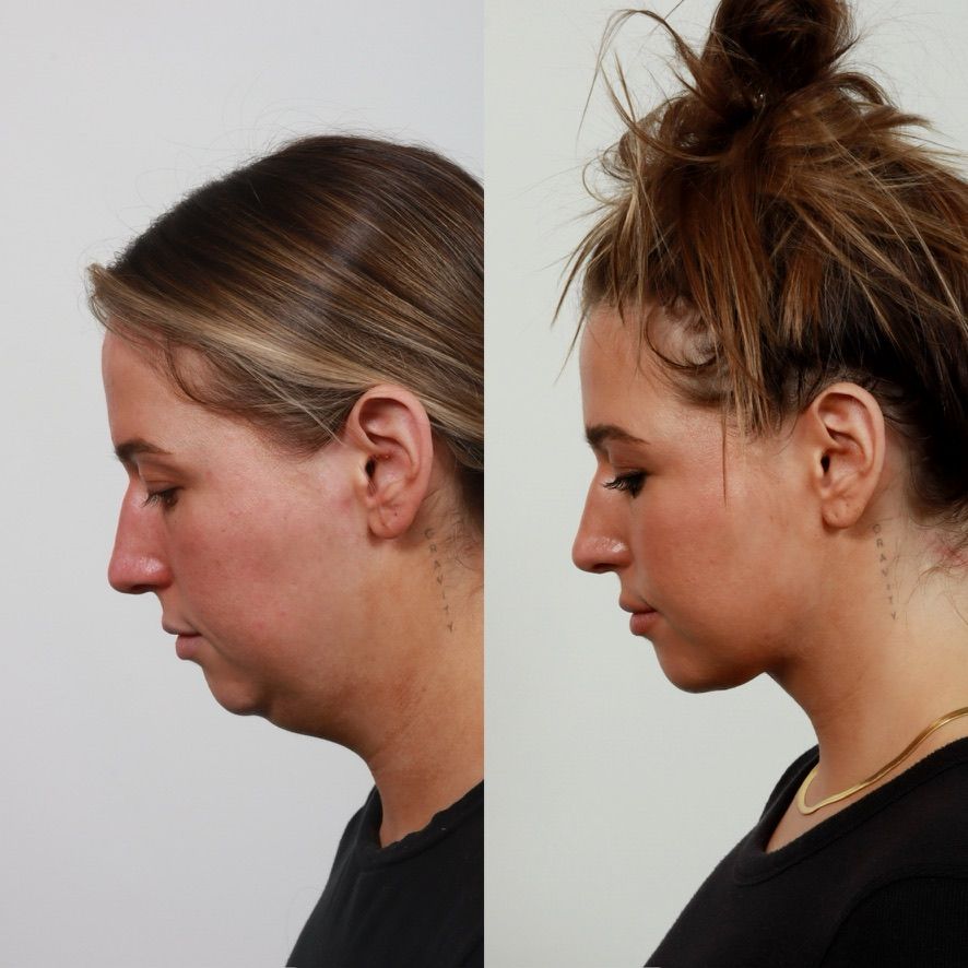 Deep Plane Neck Lift Before & After