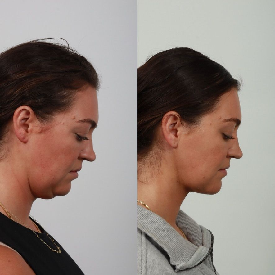 Deep Plane Neck Lift Before & After