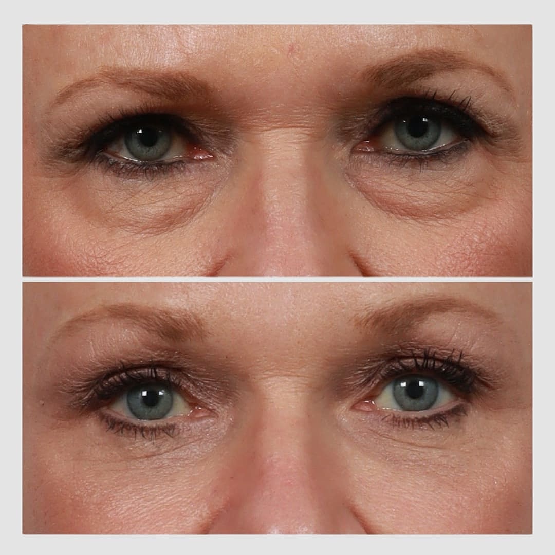 Blepharoplasty Before & After