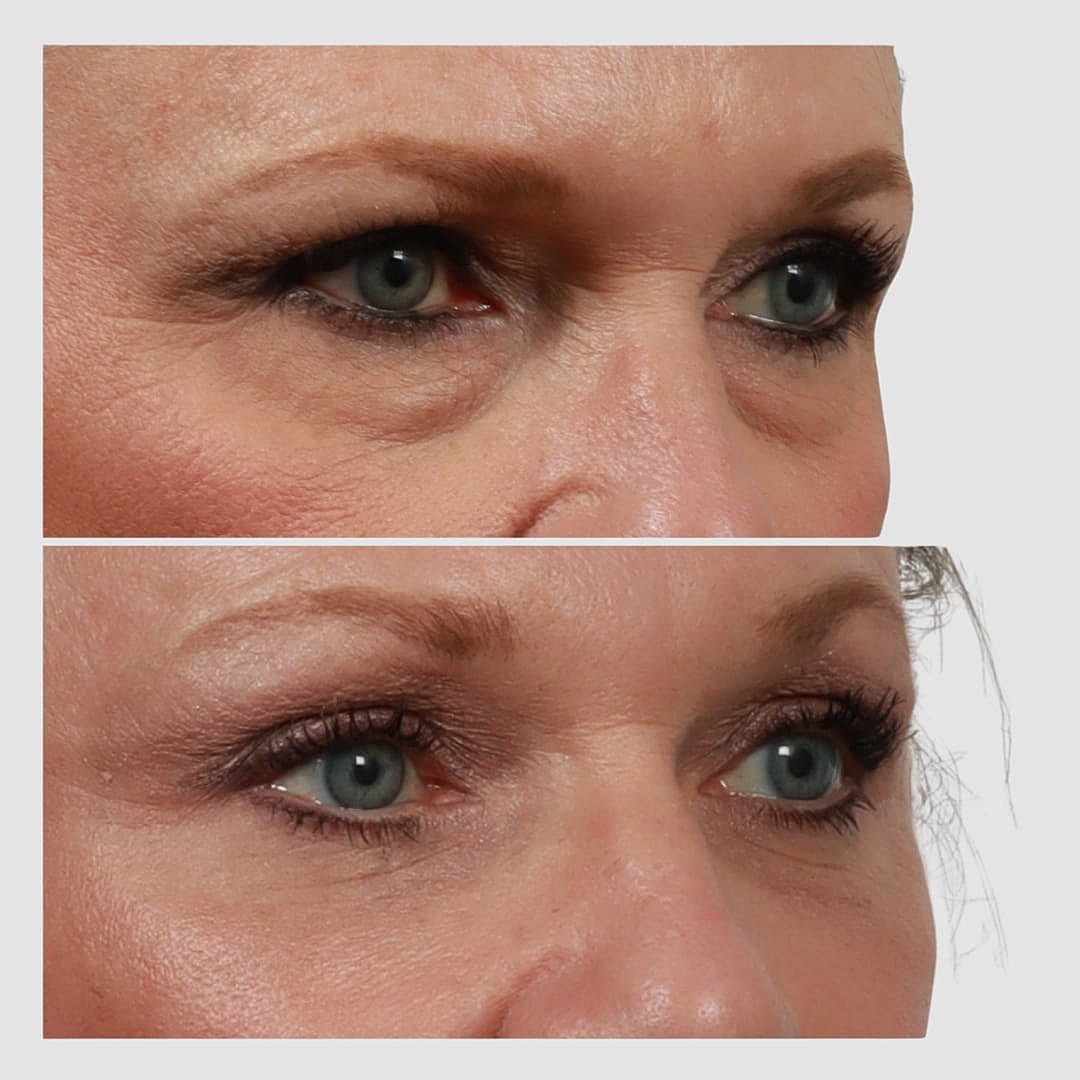 Blepharoplasty Before & After