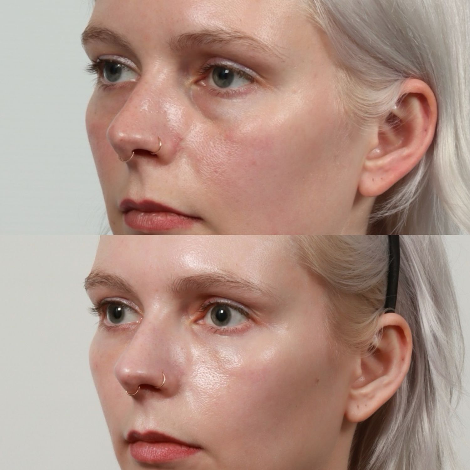 Blepharoplasty Before & After