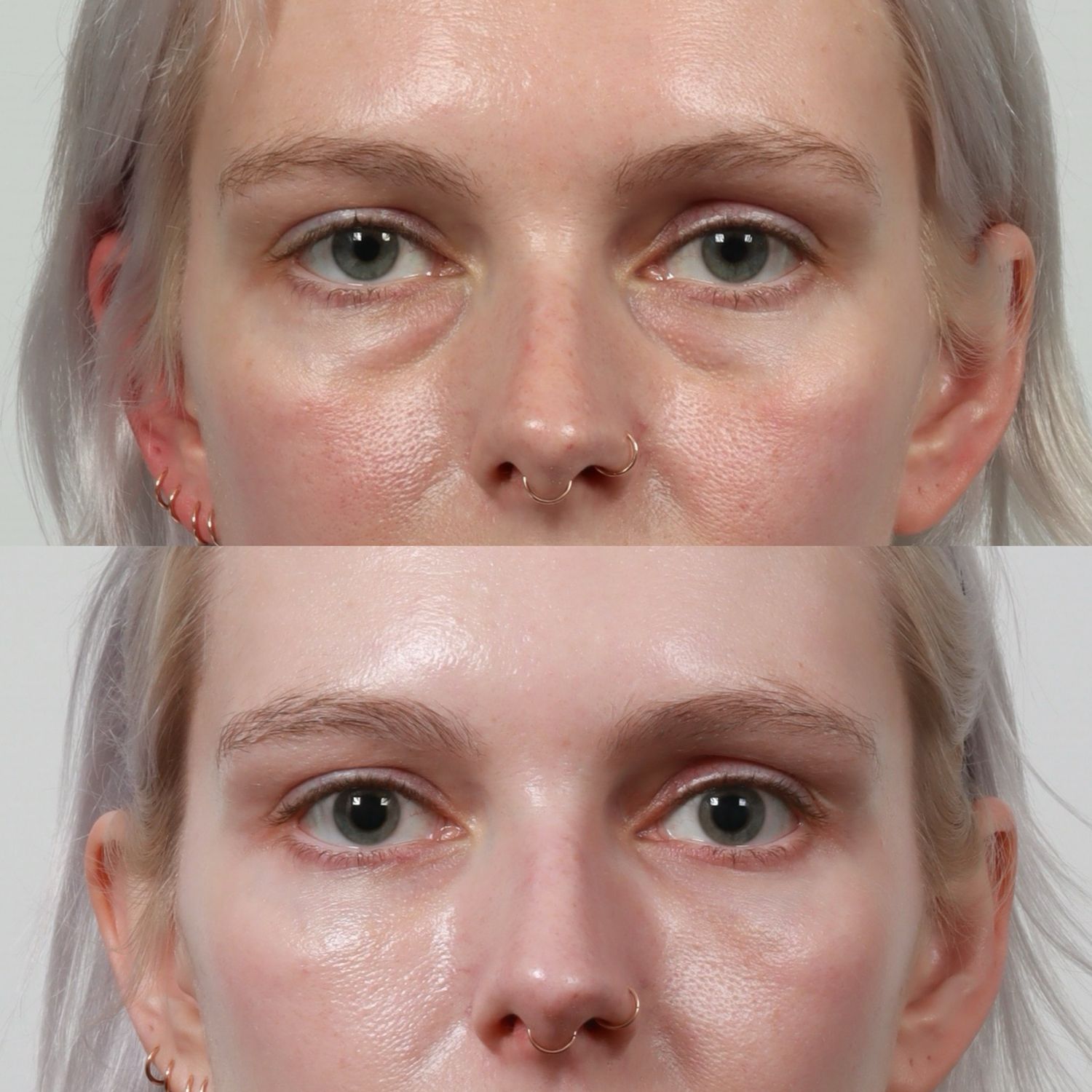 Blepharoplasty Before & After