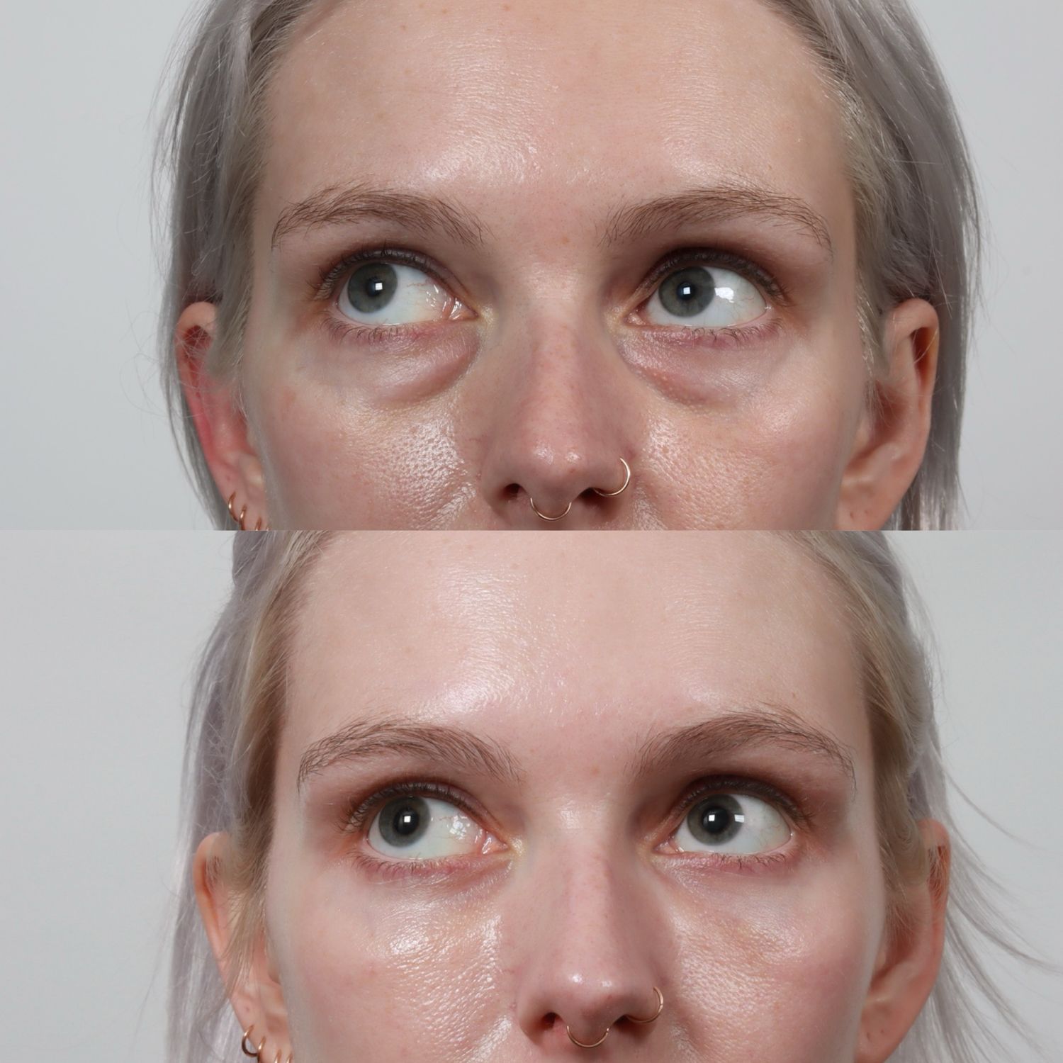 Blepharoplasty Before & After