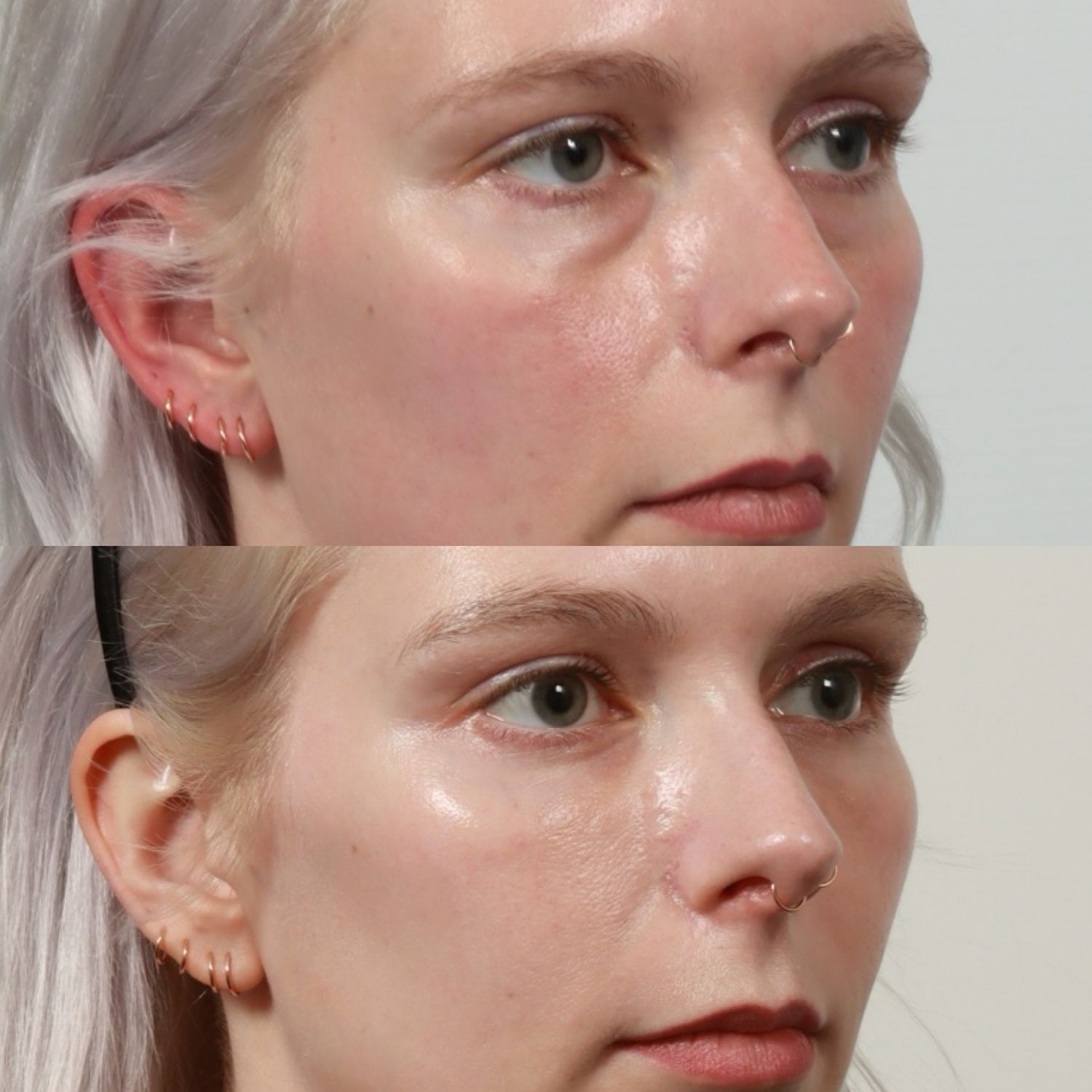 Blepharoplasty Before & After