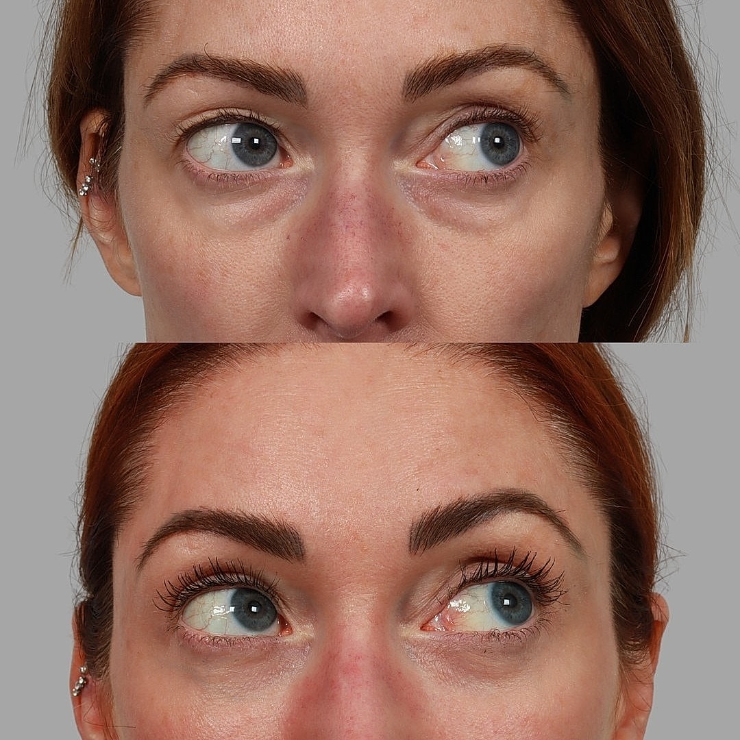 Blepharoplasty Before & After