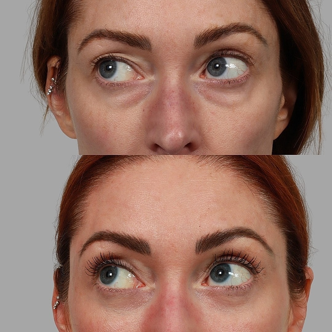 Blepharoplasty Before & After